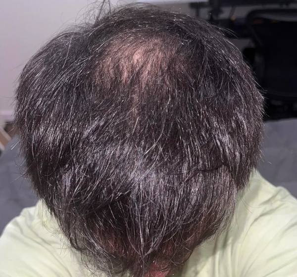 Before — ברק ש.