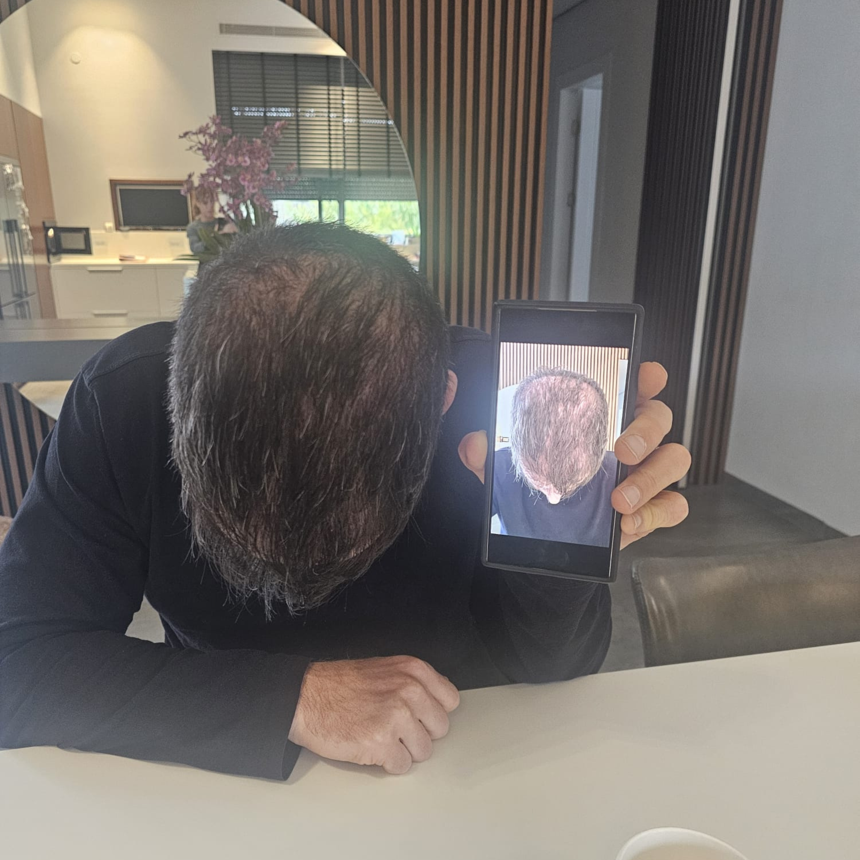 Revivex - ערכה לטיפול ושיקום נשירת שיער והתקרחות