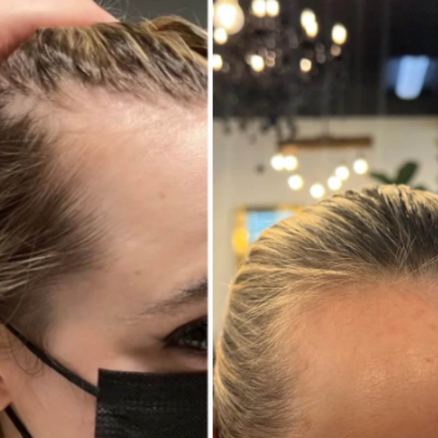 Revivex - ערכה לטיפול ושיקום נשירת שיער והתקרחות