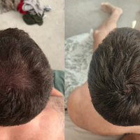 Revivex - ערכה לטיפול ושיקום נשירת שיער והתקרחות