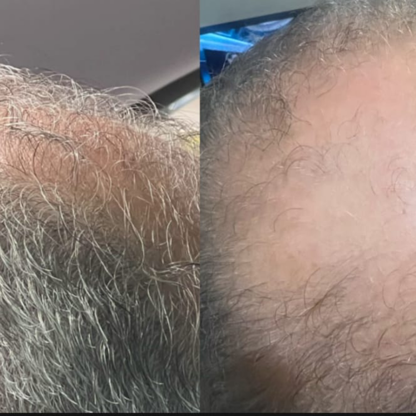 Revivex - ערכה לטיפול ושיקום נשירת שיער והתקרחות