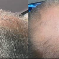 Revivex - ערכה לטיפול ושיקום נשירת שיער והתקרחות