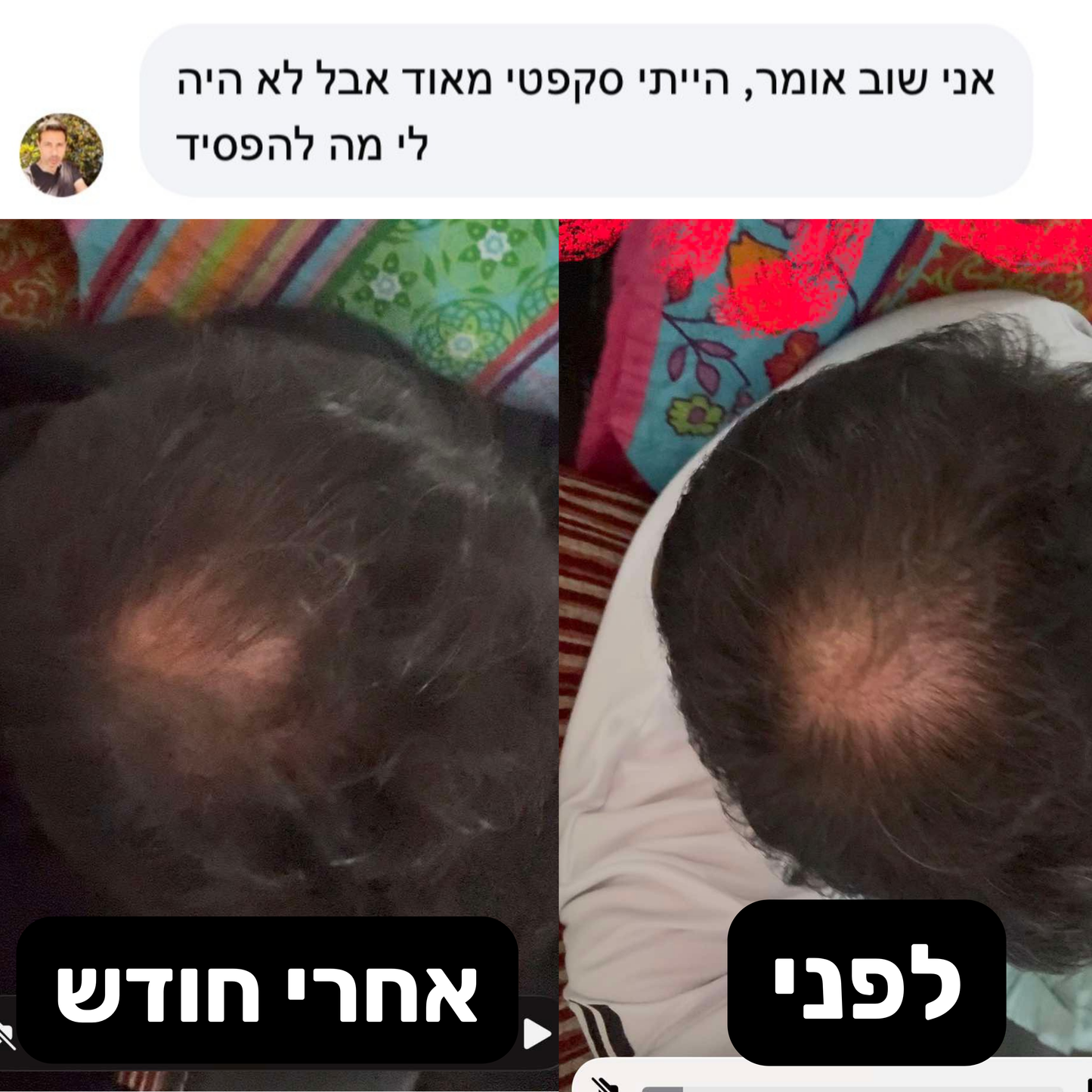 Revivex - ערכה לטיפול ושיקום נשירת שיער והתקרחות