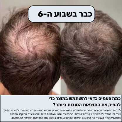 Revivex™ - ערכה לטיפול ושיקום נשירת שיער