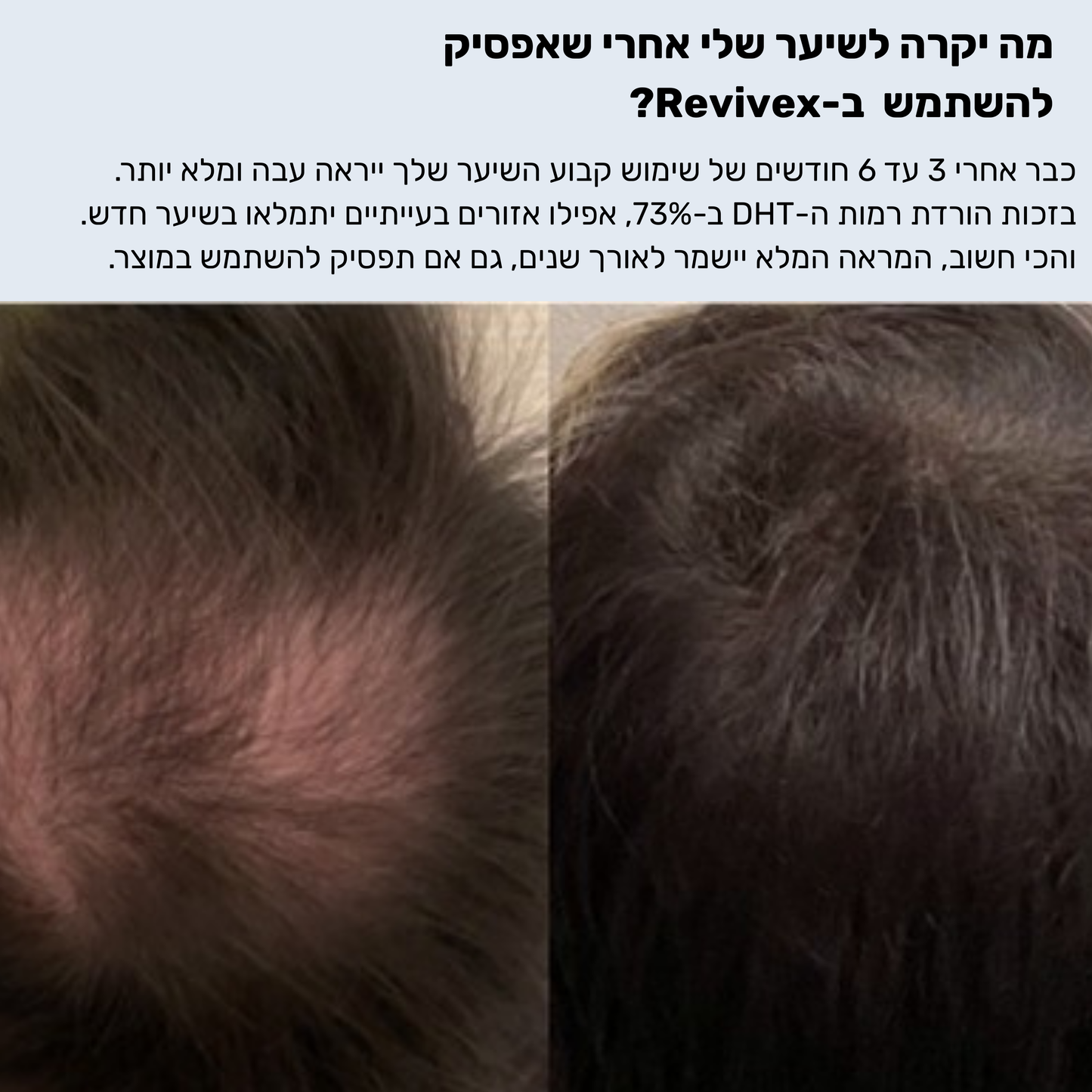 Revivex™ - ערכה לטיפול ושיקום נשירת שיער